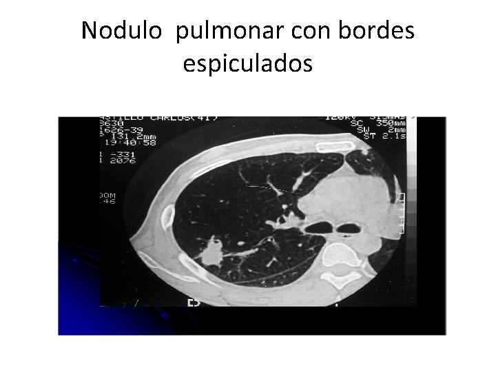 Nodulo pulmonar con bordes espiculados 