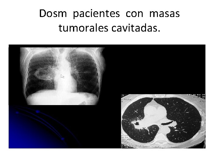Dosm pacientes con masas tumorales cavitadas. 