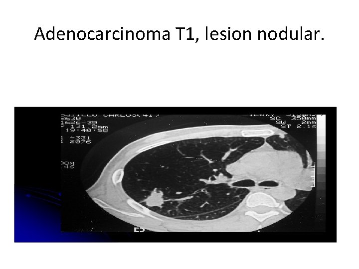 Adenocarcinoma T 1, lesion nodular. 