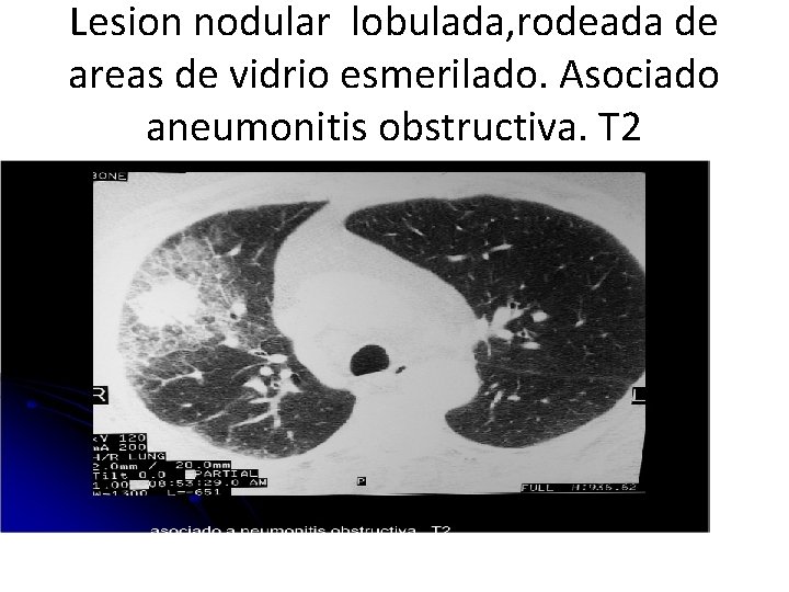 Lesion nodular lobulada, rodeada de areas de vidrio esmerilado. Asociado aneumonitis obstructiva. T 2