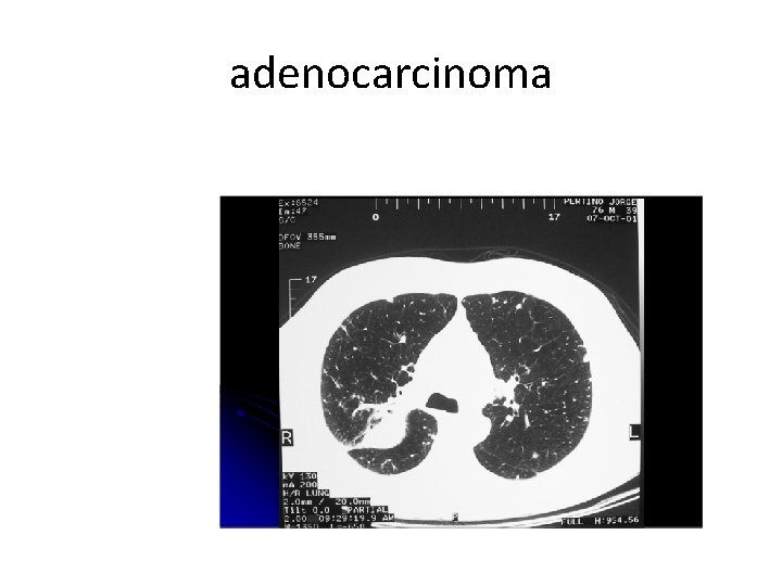 adenocarcinoma 