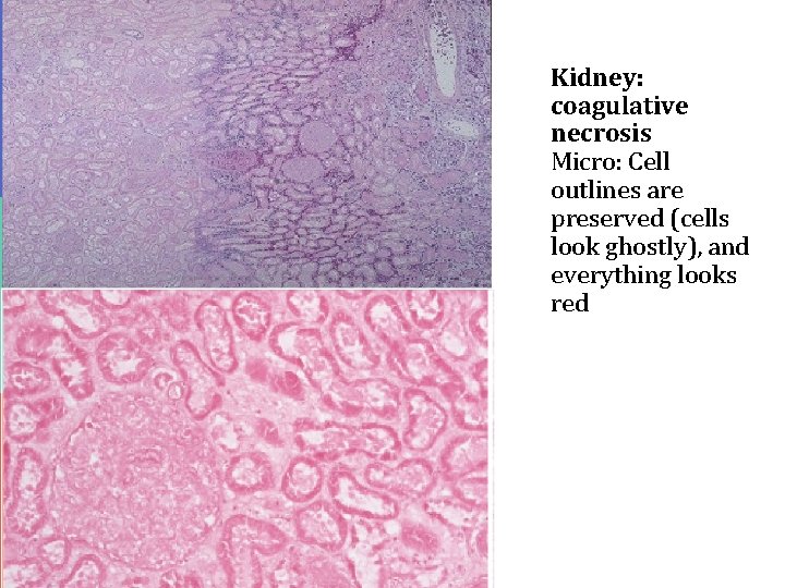 Kidney: coagulative necrosis Micro: Cell outlines are preserved (cells look ghostly), and everything looks