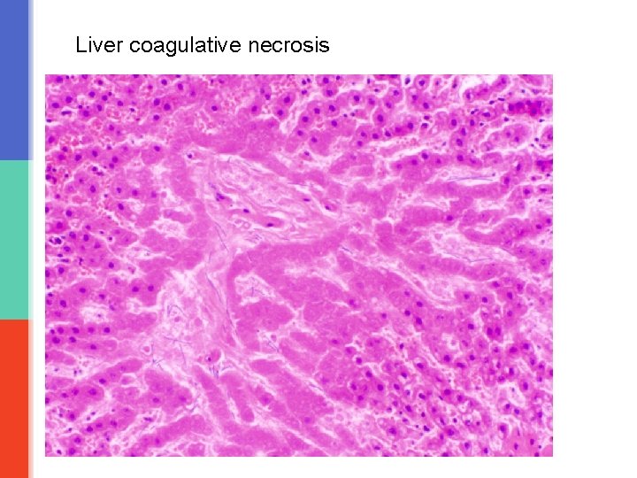 Liver coagulative necrosis 