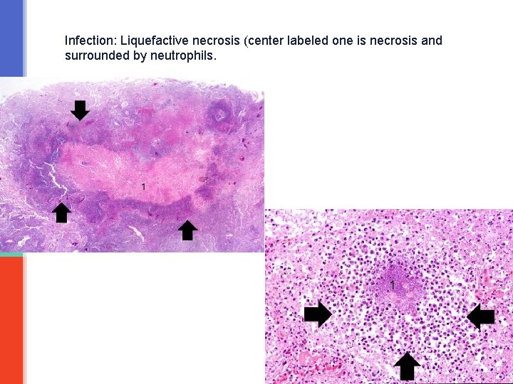 Infection: Liquefactive necrosis (center labeled one is necrosis and surrounded by neutrophils. 