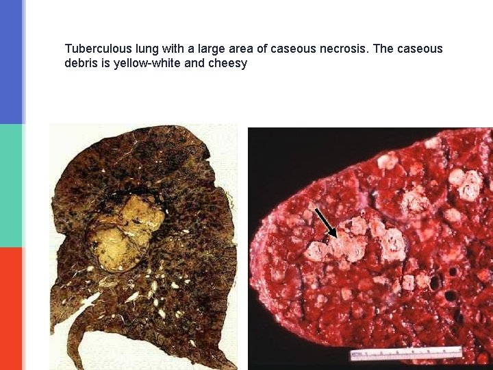 Tuberculous lung with a large area of caseous necrosis. The caseous debris is yellow-white