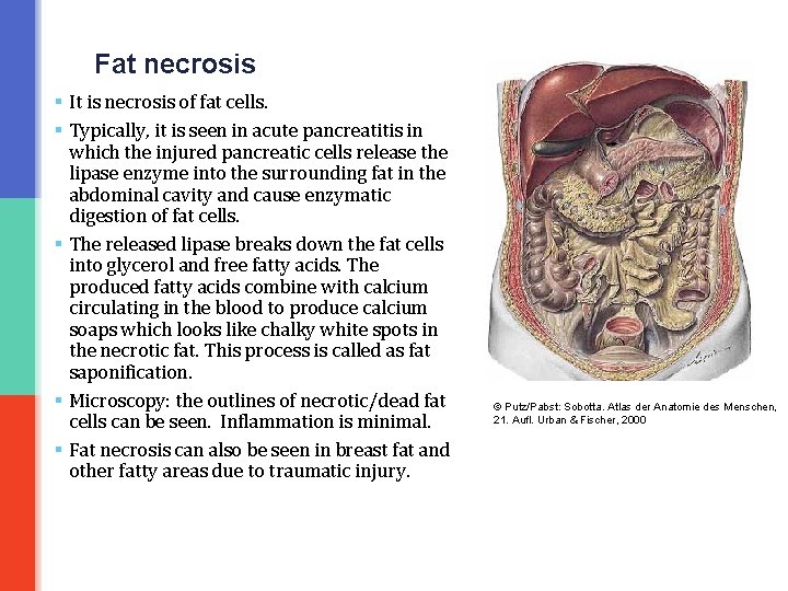 Fat necrosis § It is necrosis of fat cells. § Typically, it is seen