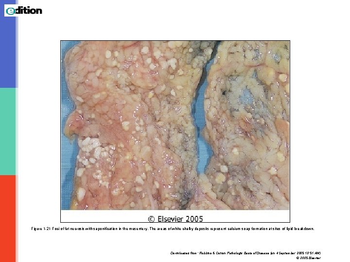 Figure 1 -21 Foci of fat necrosis with saponification in the mesentery. The areas