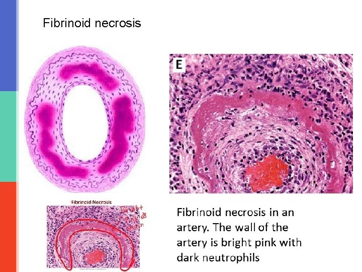Fibrinoid necrosis 