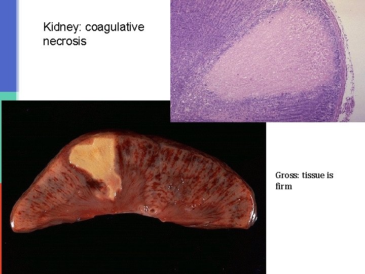 Kidney: coagulative necrosis Gross: tissue is firm 