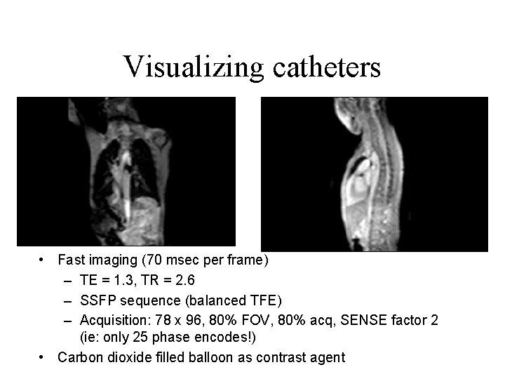 Visualizing catheters • Fast imaging (70 msec per frame) – TE = 1. 3,