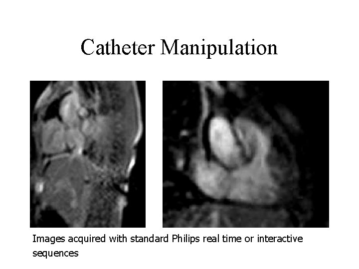 Catheter Manipulation Images acquired with standard Philips real time or interactive sequences 