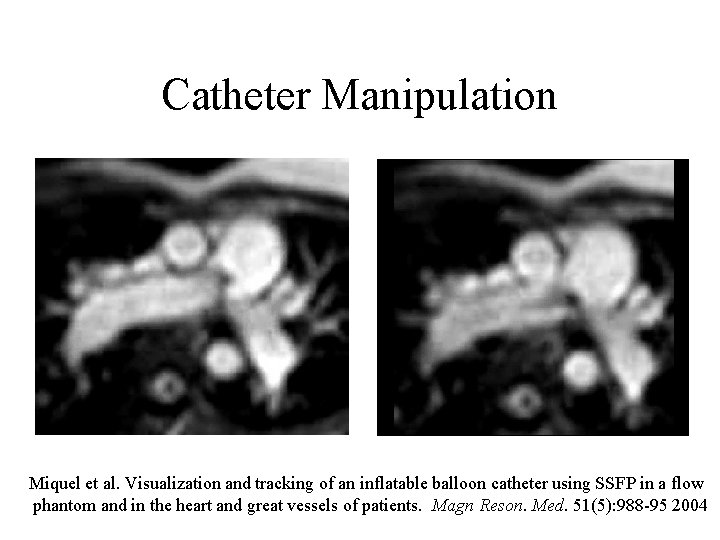 Catheter Manipulation Miquel et al. Visualization and tracking of an inflatable balloon catheter using