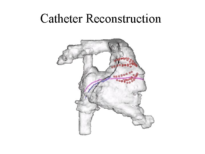 Catheter Reconstruction 
