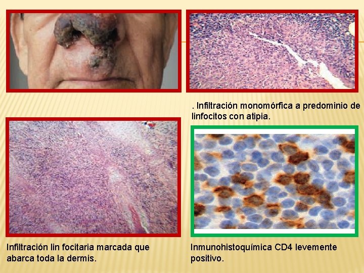 Infiltración lin focitaria marcada que abarca toda la dermis. HE Inmunohistoquímica CD 4 levemente