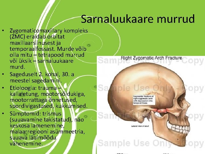 Sarnaluukaare murrud • Zygomaticomaxillary kompleks (ZMC) eraldab orbitat maxillaarsiinusest ja temporaalfossast. Murde võib olla