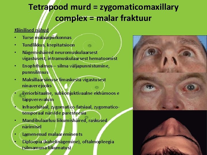 Tetrapood murd = zygomaticomaxillary complex = malar fraktuur Kliinilised nähud • Turse malaarpiirkonnas •