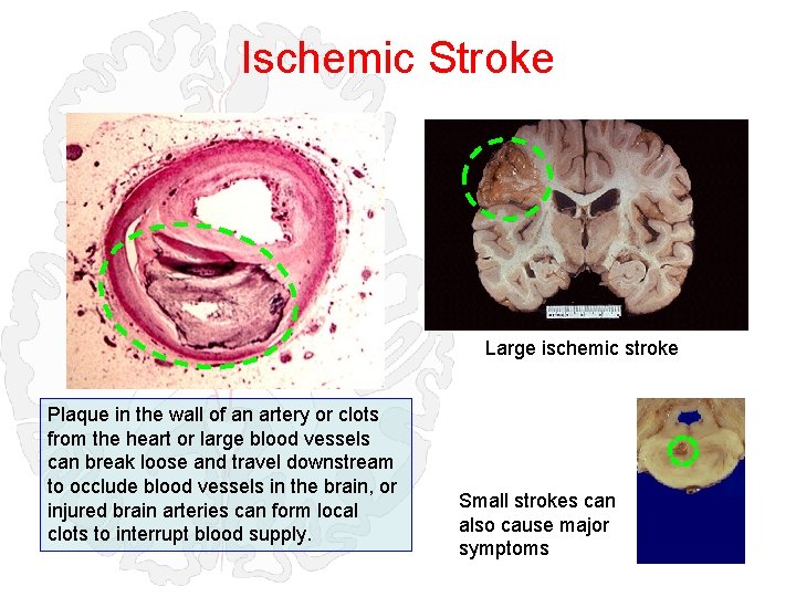 Ischemic Stroke Large ischemic stroke Plaque in the wall of an artery or clots