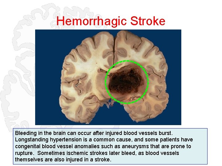 Hemorrhagic Stroke Bleeding in the brain can occur after injured blood vessels burst. Longstanding