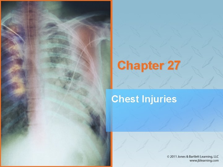 Chapter 27 Chest Injuries 