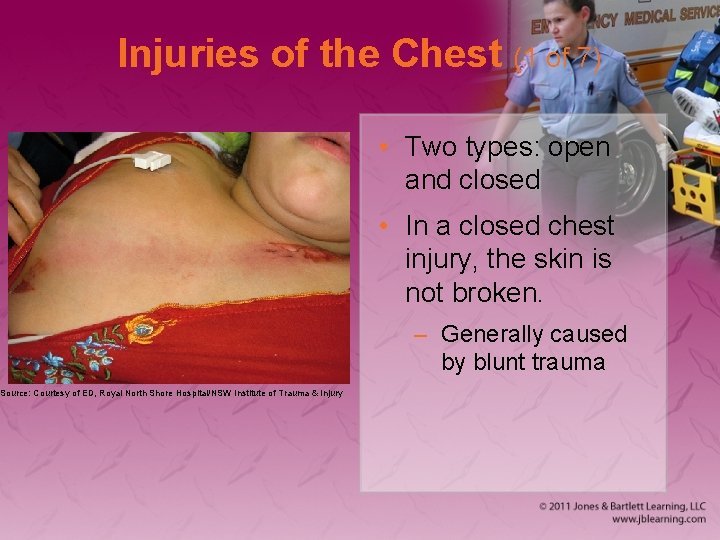 Injuries of the Chest (1 of 7) Source: Courtesy of ED, Royal North Shore