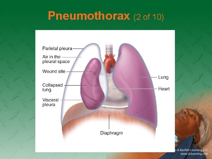 Pneumothorax (2 of 10) 
