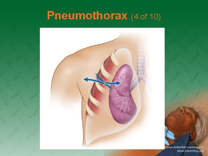 Pneumothorax (4 of 10) 