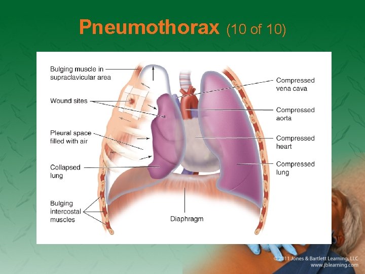 Pneumothorax (10 of 10) 