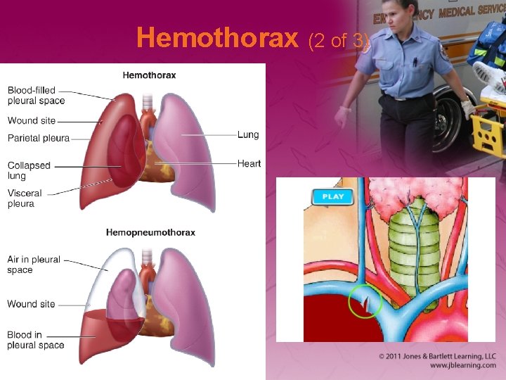 Hemothorax (2 of 3) 