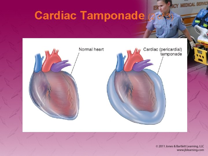 Cardiac Tamponade (2 of 3) 