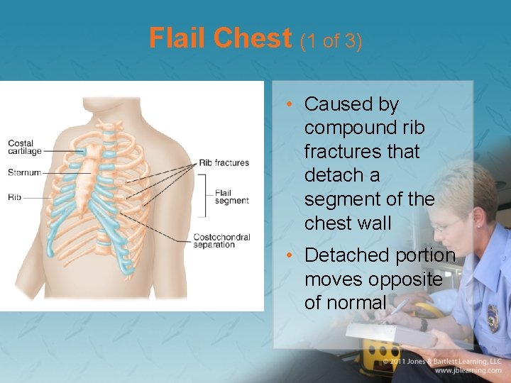 Flail Chest (1 of 3) • Caused by compound rib fractures that detach a