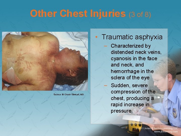 Other Chest Injuries (3 of 8) • Traumatic asphyxia Source: © Chuck Stewart, MD.