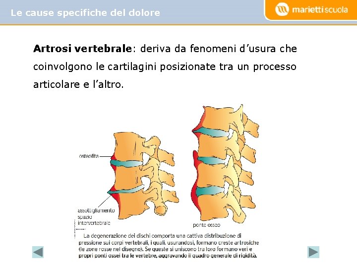 Le cause specifiche del dolore Artrosi vertebrale: deriva da fenomeni d’usura che coinvolgono le