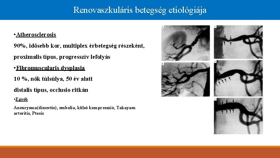 renovaszkuláris hipertónia)