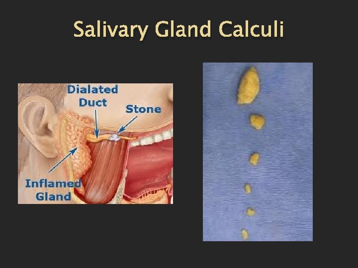 Salivary Gland Calculi 