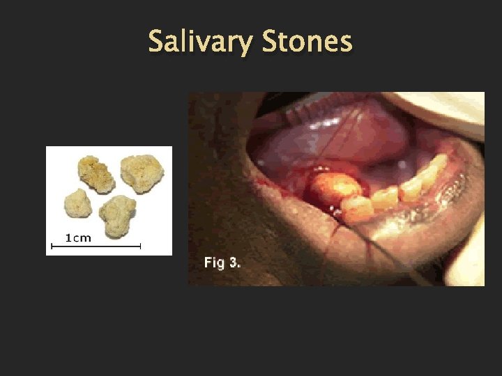Salivary Stones 