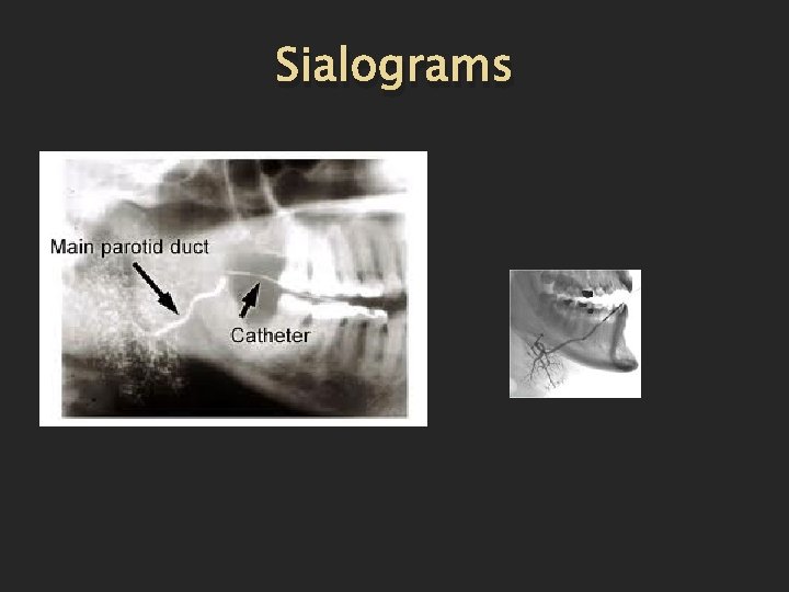 Sialograms 