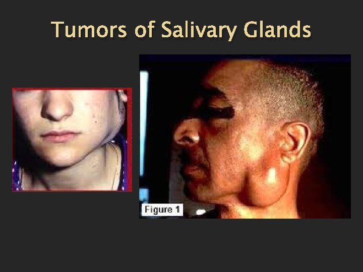 Tumors of Salivary Glands 