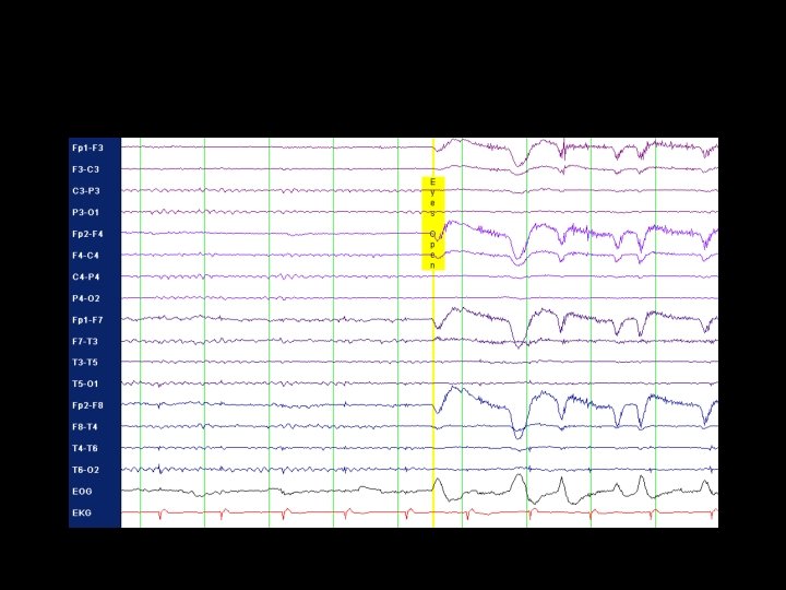 Eeg Rimer Classic EEG Abnormalities Academic HalfDay June 5 th