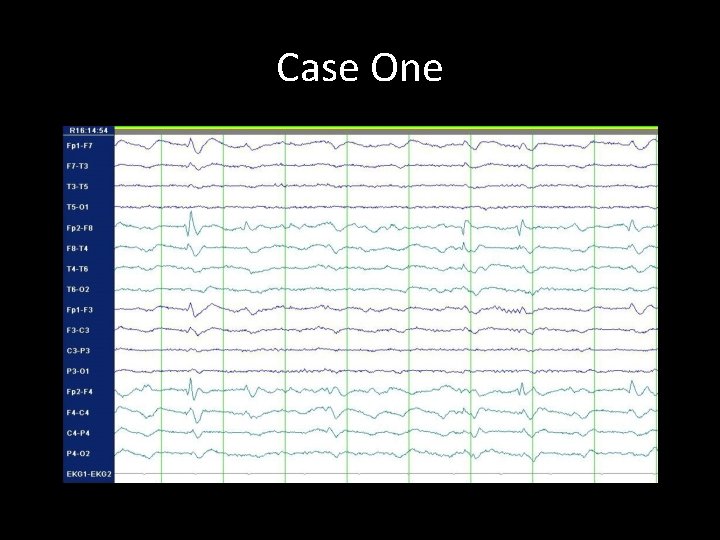 Eeg Rimer Classic EEG Abnormalities Academic HalfDay June 5 th