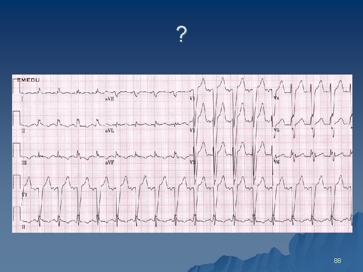 1 Conduction Disturbances 2 Sinus Bradycardia Sinus Tachycardia