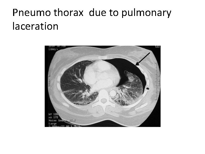 Pneumo thorax due to pulmonary laceration 
