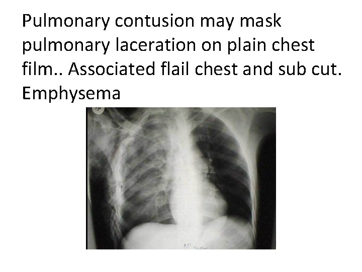 Pulmonary contusion may mask pulmonary laceration on plain chest film. . Associated flail chest