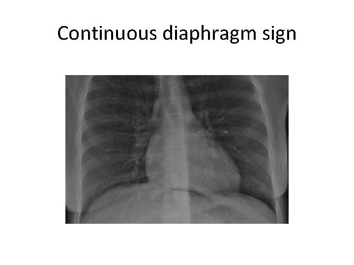 Continuous diaphragm sign 