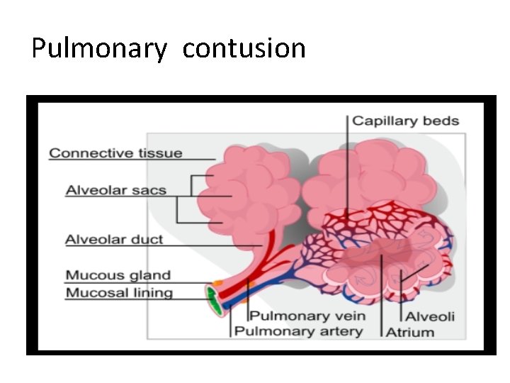 Pulmonary contusion 