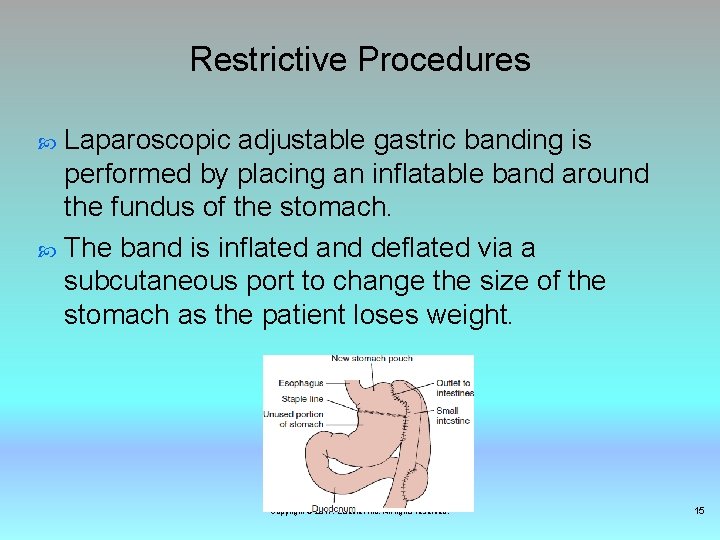 Restrictive Procedures Laparoscopic adjustable gastric banding is performed by placing an inflatable band around