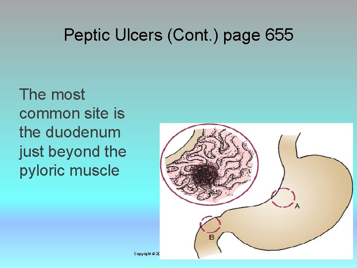 Peptic Ulcers (Cont. ) page 655 The most common site is the duodenum just