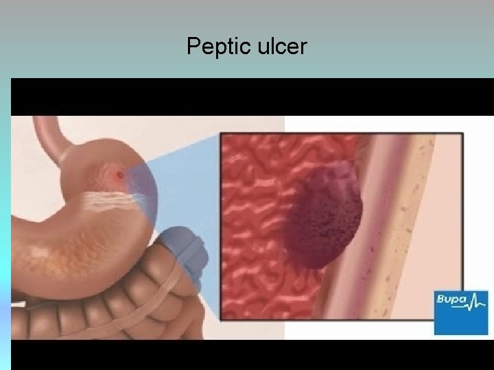 Peptic ulcer 46 