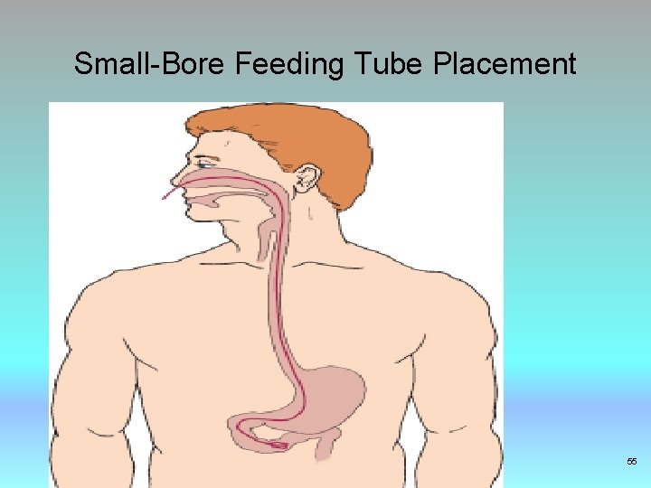 Small-Bore Feeding Tube Placement Copyright © 2017, Elsevier Inc. All rights reserved. 55 