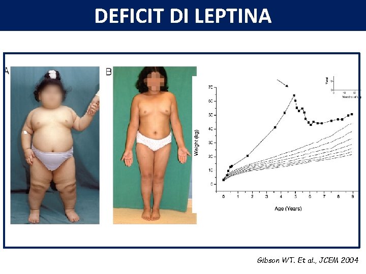 DEFICIT DI LEPTINA Gibson WT. Et al. , JCEM 2004 