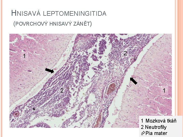 HNISAVÁ LEPTOMENINGITIDA (POVRCHOVÝ HNISAVÝ ZÁNĚT) 2 1 1 Mozková tkáň 2 Neutrofily Pia mater